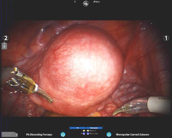 Laparoscopy