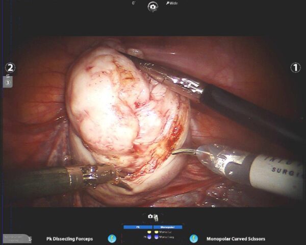 Laparoscopy2