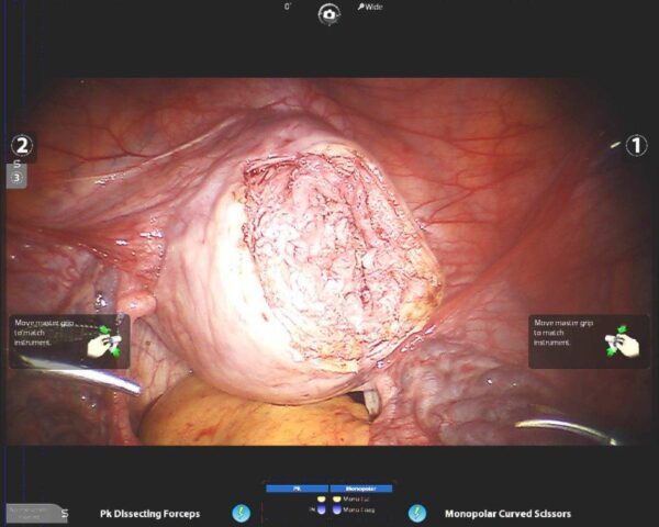 Laparoscopy4