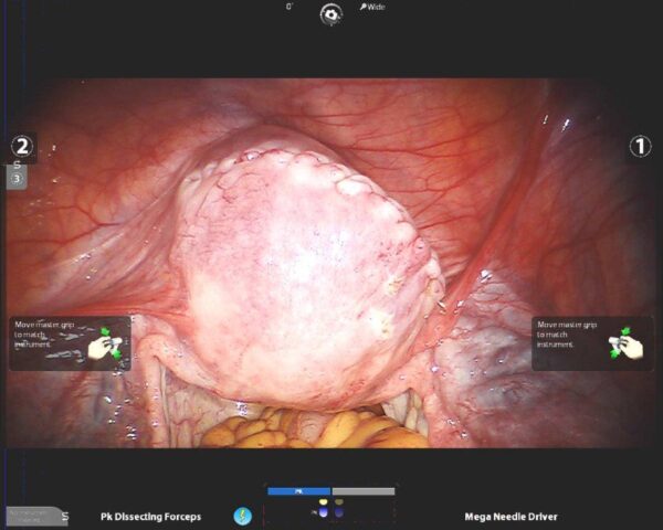 Laparoscopy5