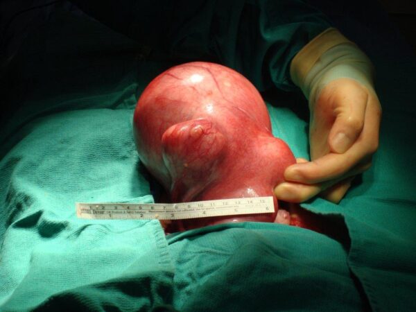 Uterus enlarged with may fibroids